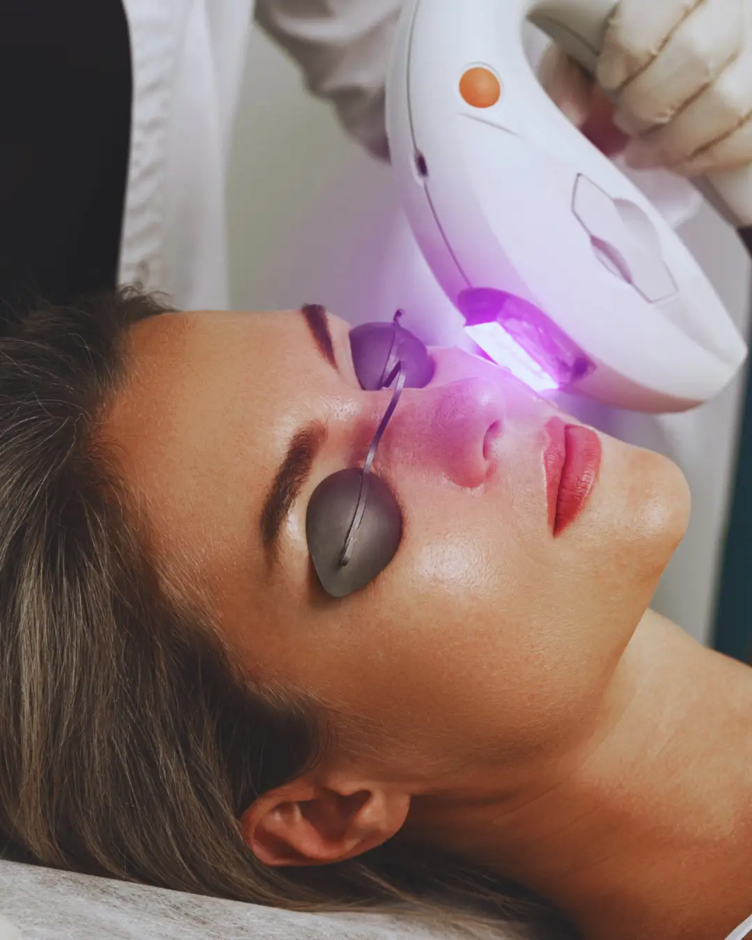 Fotorejuvenecimiento IPL